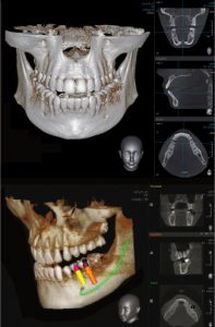 3D-Darstellung eines Kiefers mit DVT-Aufnahmen