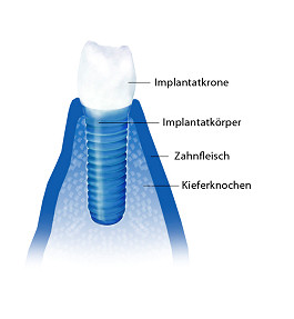 Schema eines Zahnimplantats mit Implantatkrone, Implantatkörper, Zahnfleisch und Kieferknochen