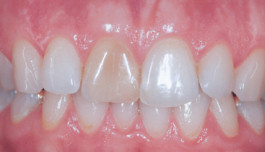 Frontzähne vor einer Veneer-Versorgung