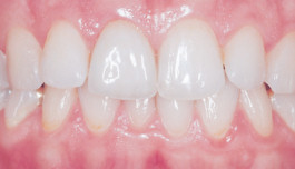 Frontzähne nach einer ästhetischen Versorgung mit Veneers