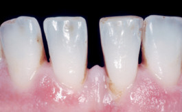 Vorbereitung der Frontzähne für Veneers