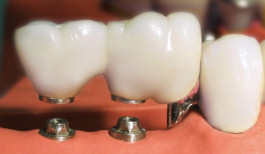 Zahn-implantat Zahnarzt Heidelberg